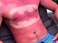 Sunburn Art o Tatuaje solar – Una nueva moda que puede resultar muy peligrosa