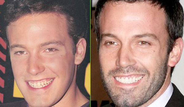 Ben-Affleck-dientes-antes-y-despues