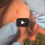 Extraen gusano alojado en ojo de adolescente utilizando hojas de albahaca
