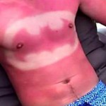 Sunburn Art o Tatuaje solar - Una nueva moda que puede resultar muy peligrosa